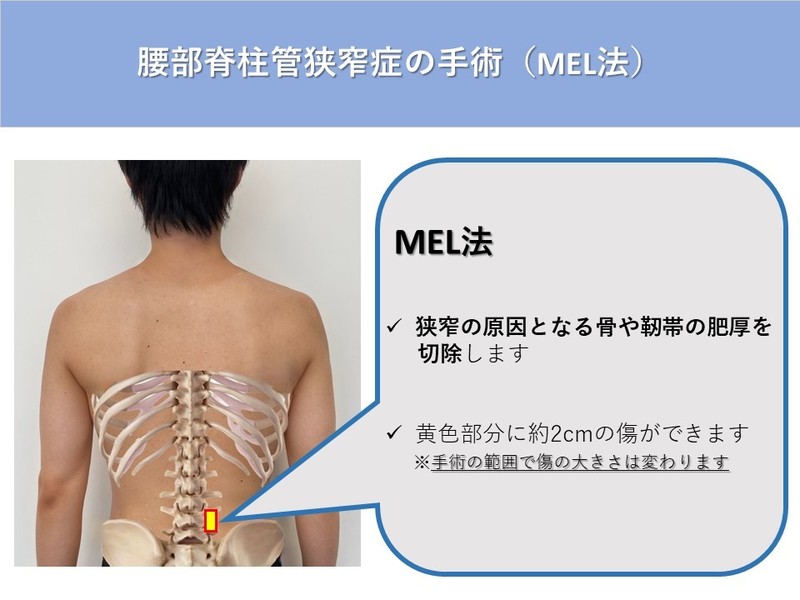 腰部脊柱管狭窄症の手術 | AR-Ex Medical Group（アレックス）｜東京