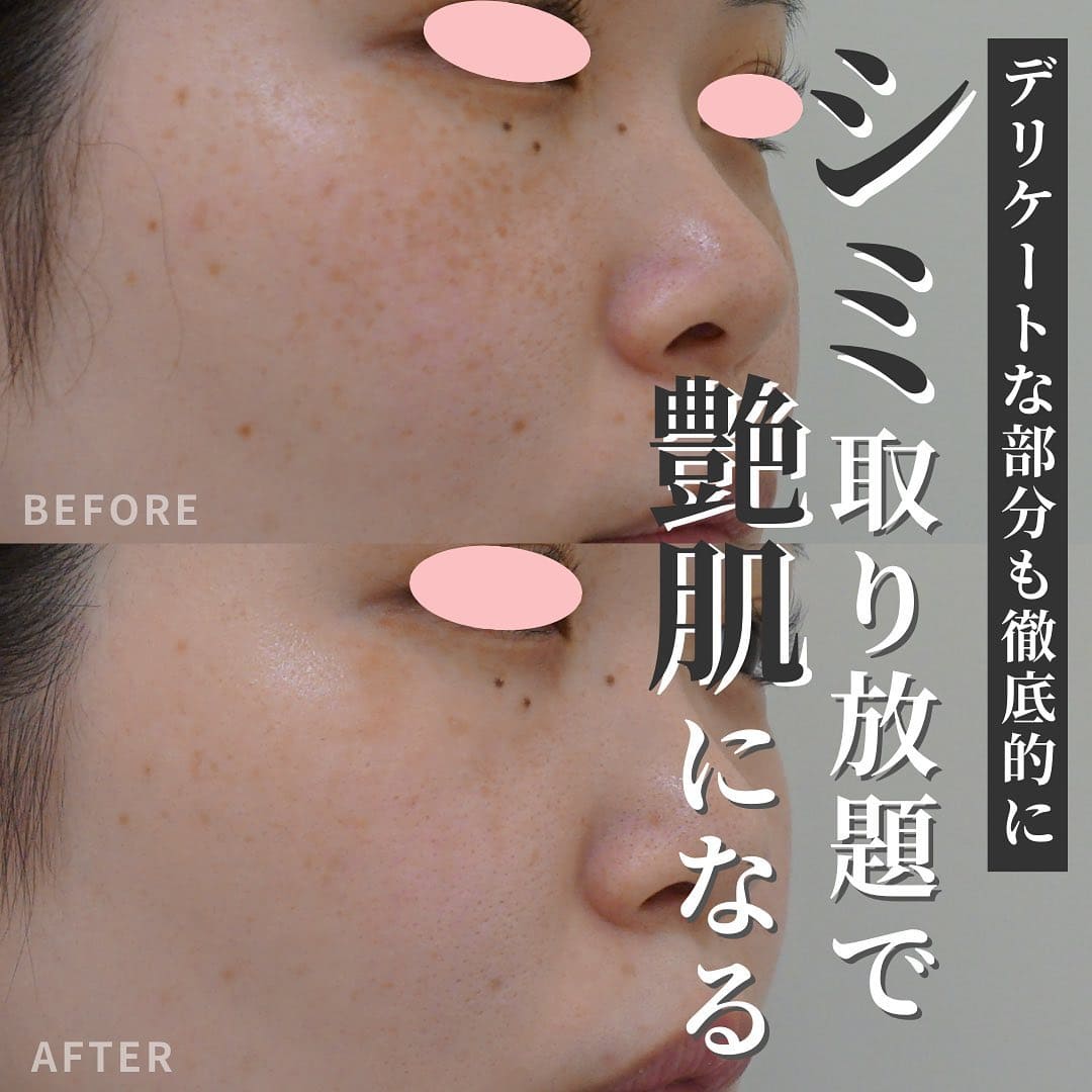 デリケートな部分も徹底的に シミ取り放題で艶肌になる | 恵比寿駅徒歩