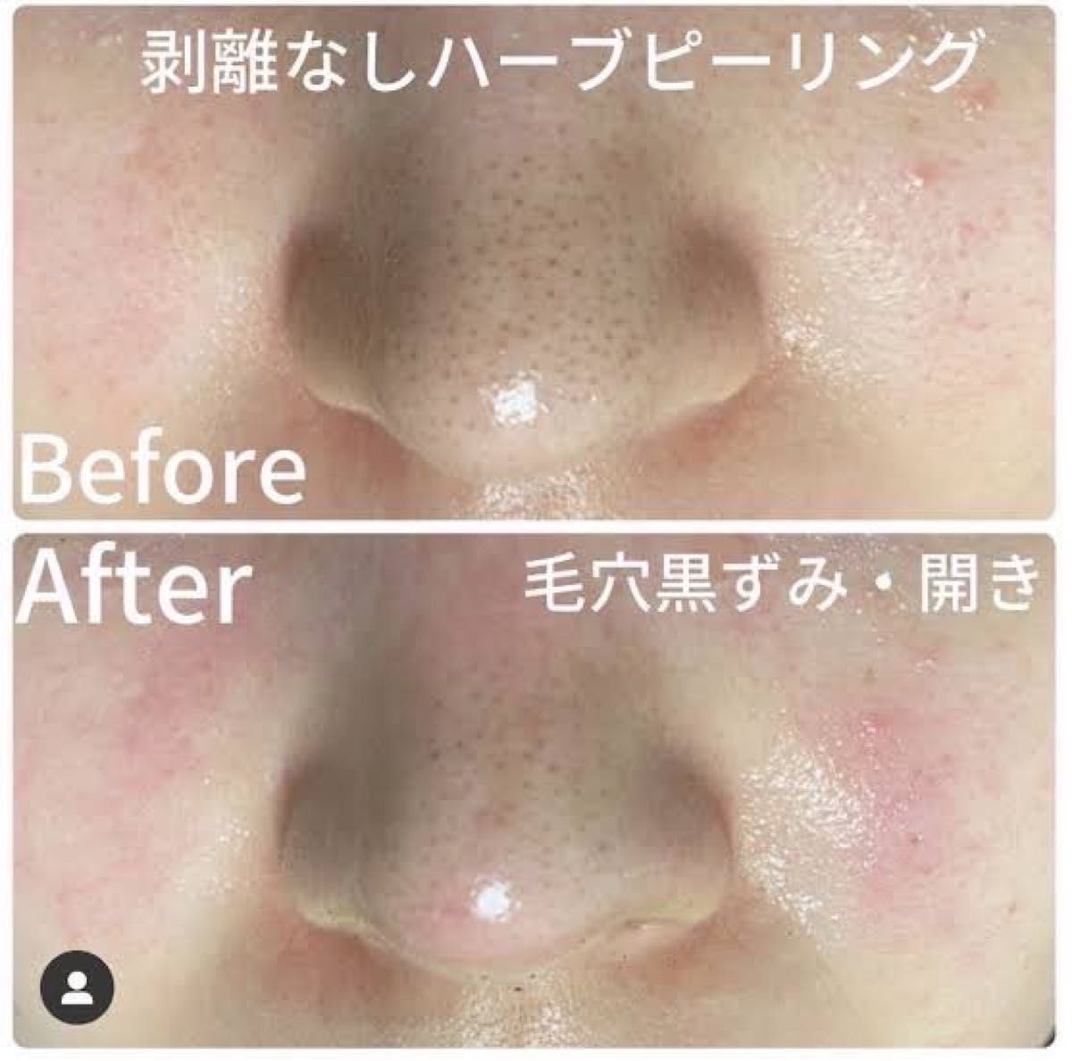 剥離なし ハーブピーリング8回分｜Yahoo!フリマ（旧PayPayフリマ）