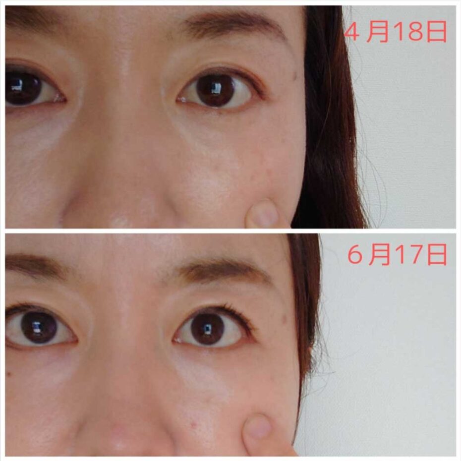 シミ改善スキンケア2ヶ月間レポート（アンティスポットホワイト