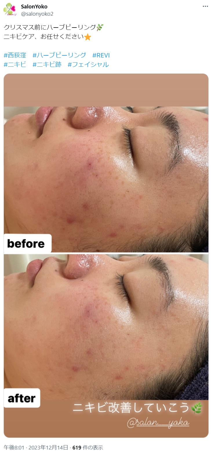 REVI(ルヴィ)ハーブピーリングの効果とは？効果なしと言われる理由や