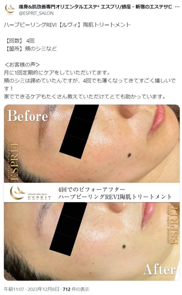 REVI(ルヴィ)ハーブピーリングの効果とは？効果なしと言われる理由や