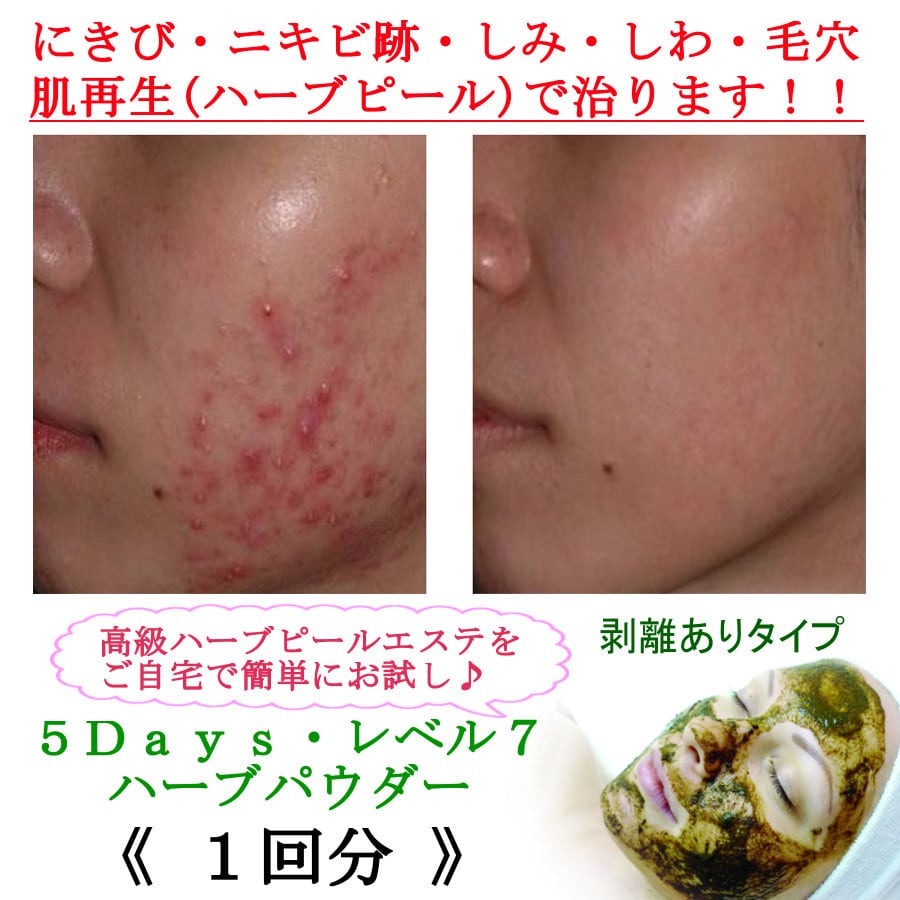 剥離有り】ハーブピールパウダー1回分 | -Herb Peel-