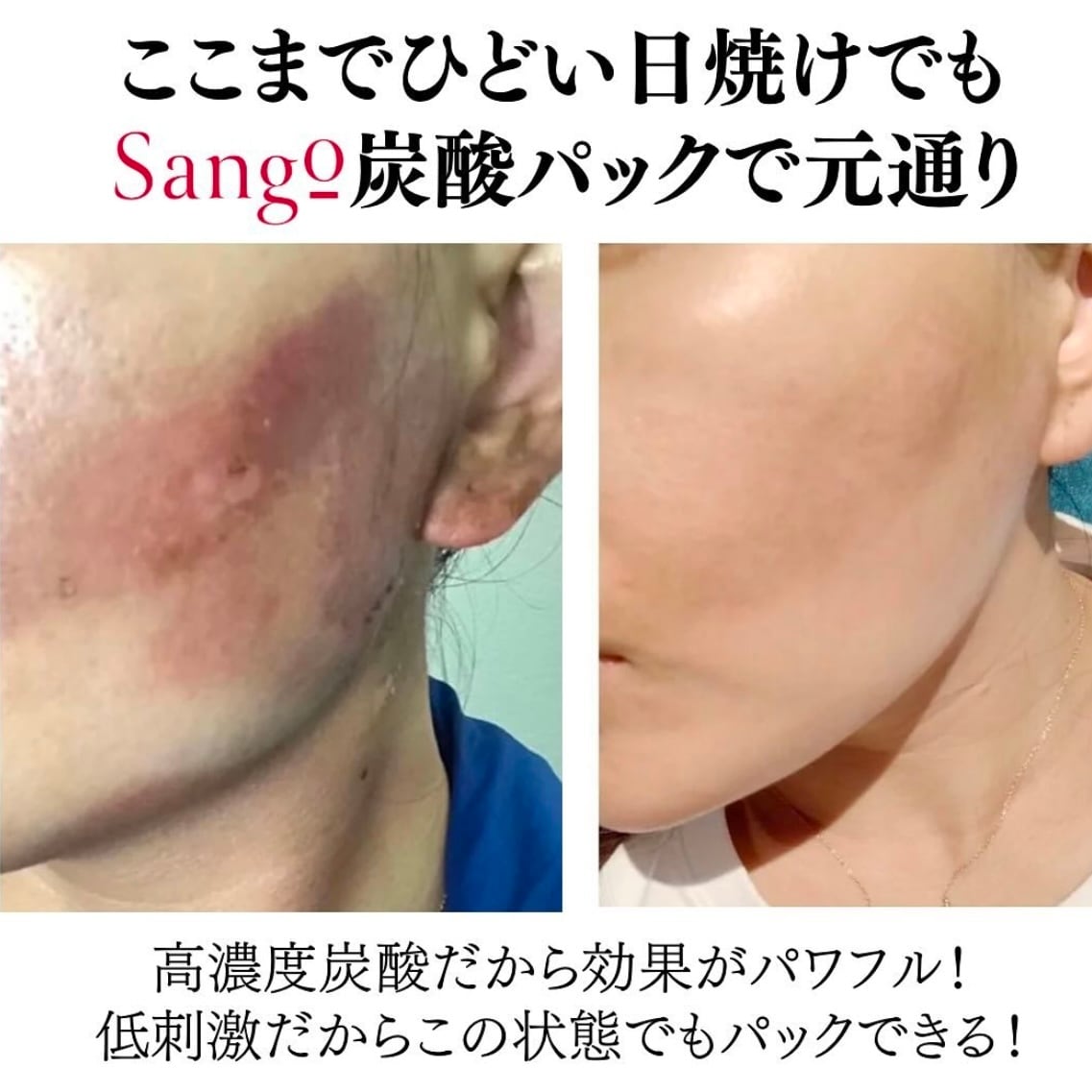 Sango】ダブルエナジーCO2ジェル5回分(高濃度炭酸パック) | nemuriselect