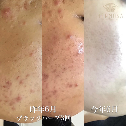 美骨艶肌サロン TORIE（トリエ） | HERMOSA