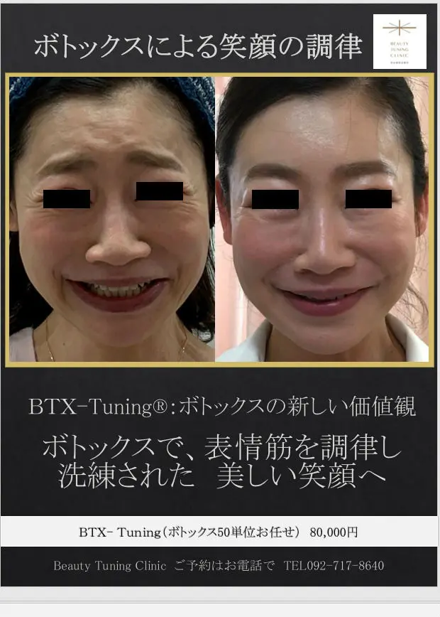 ボトックス注射による笑顔の調律（BTX-Tuning®︎）症例：ボトックス