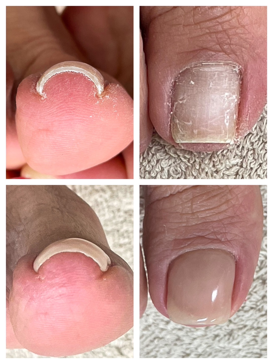 Hey Switch 巻き爪ケアジェル講習 - ベラルナ