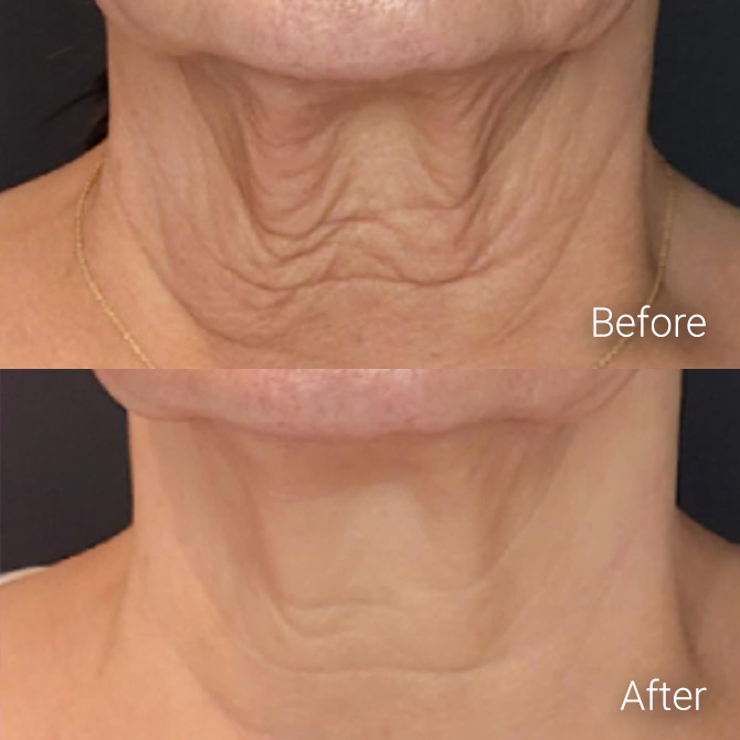 Non-Surgical Skin Tightening - Livingston, NJ | Berlin Beauty