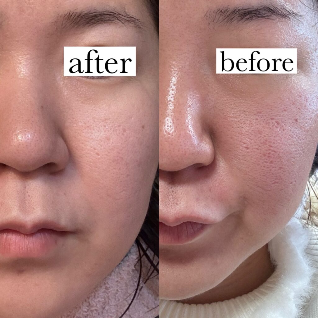 REVIハーブピーリングのリピート率、効果が高い3つの理由