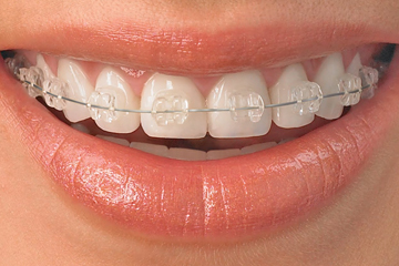 歯列矯正 | 港区六本木でホワイトニングや審美的治療に特化した