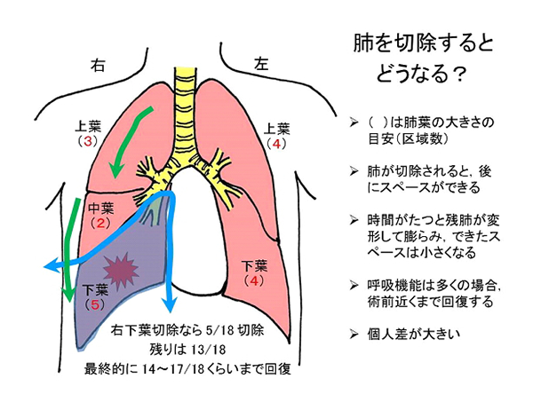 肺がん – 愛知県がんセンター
