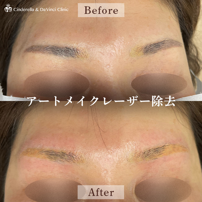 アートメイクの症例一覧 | 名古屋の美容外科・美容皮膚科なら