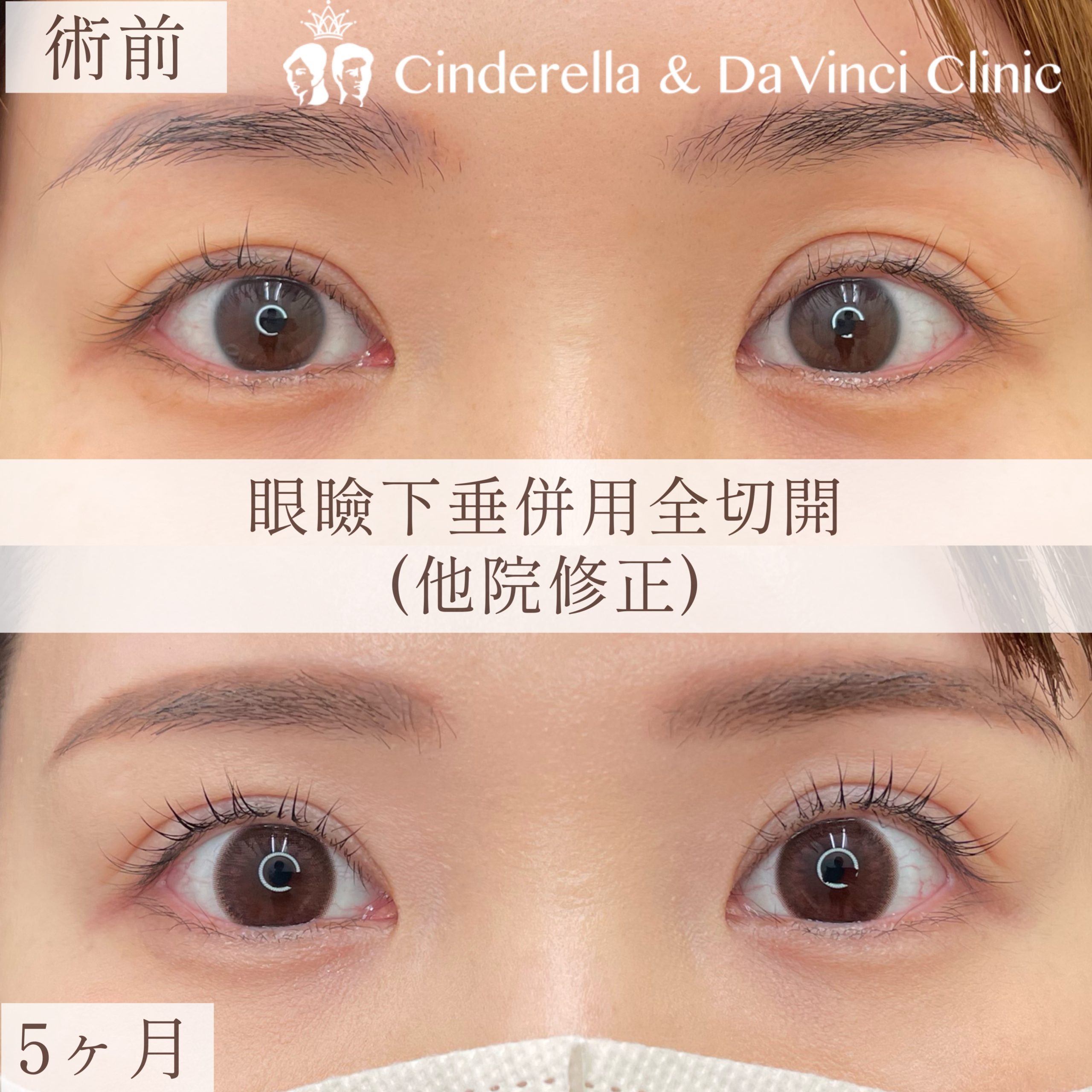 眼瞼下垂手術 | 名古屋の美容外科・美容皮膚科ならCinderella & Da