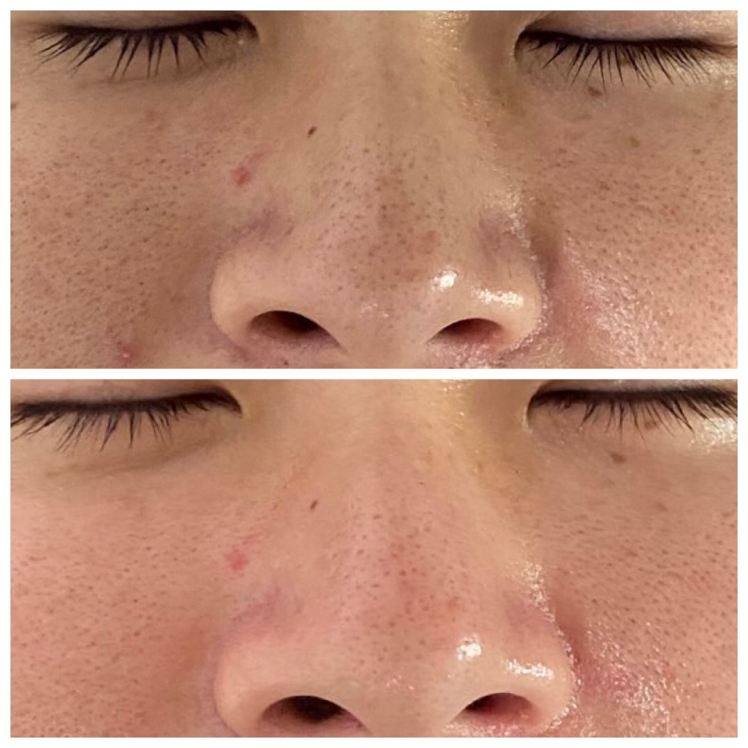 今話題のハイドロスプラッシュ🌟 | シミ・毛穴ケアサロンcozy｜京都