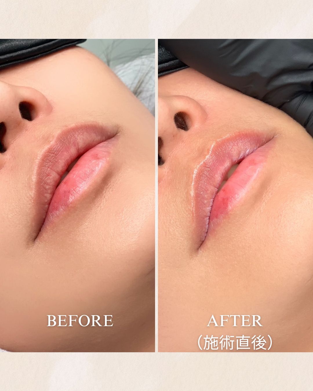 ローマピンク｜唇・デリケートゾーンの黒ずみ改善ならローマピンク公式