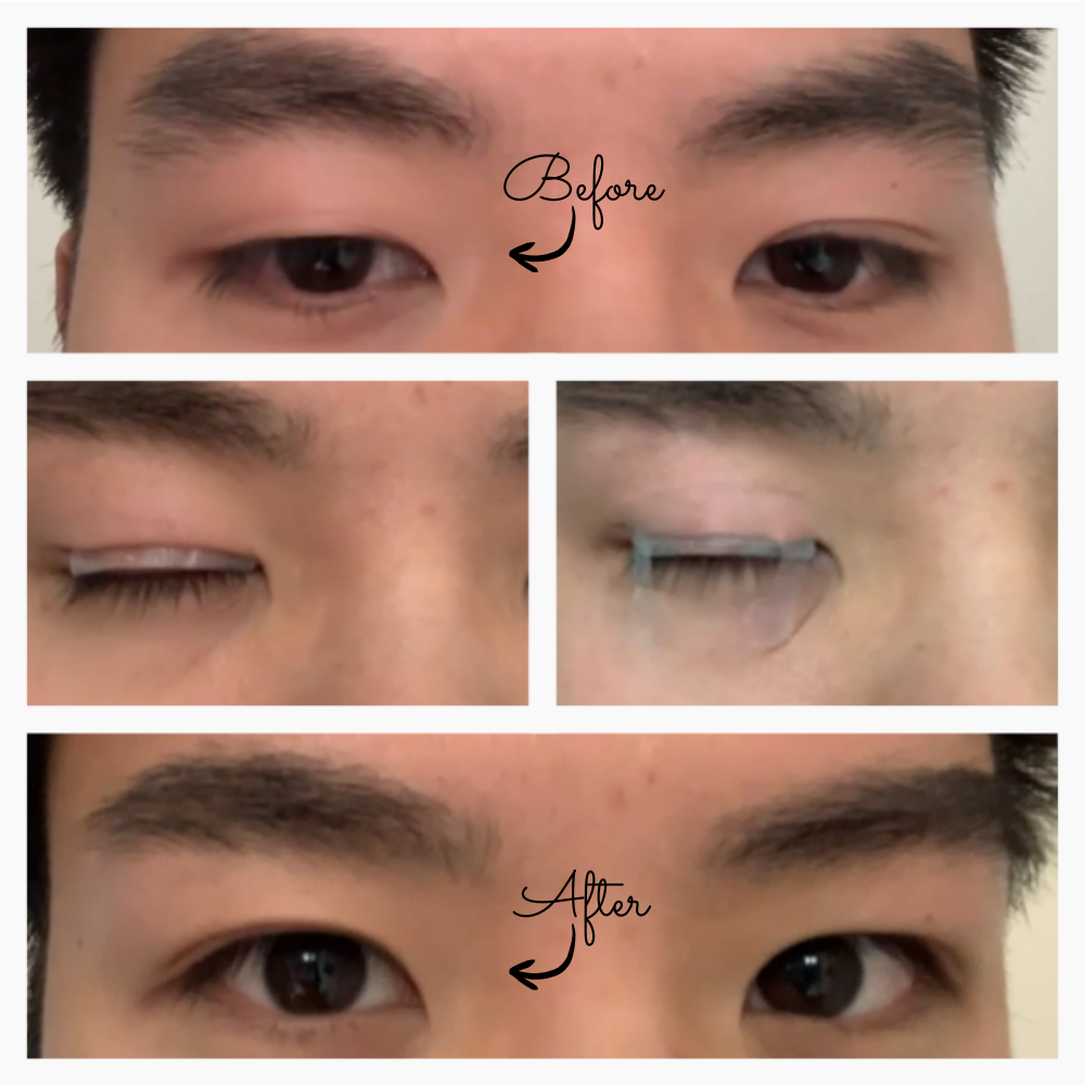OPTIFOLD Double Eyelid Tapes - Wear at night, results last for days!