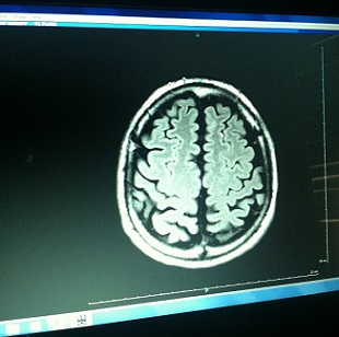 Infant Brain Scans May Predict Autism Diagnosis | The Scientist