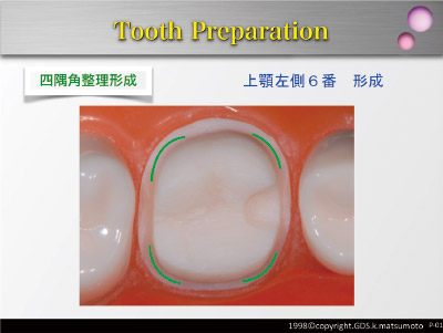 モリタ】コンセプト優先型支台歯形成用 バーセット「SELF CREATOR