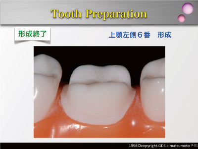 モリタ】コンセプト優先型支台歯形成用 バーセット「SELF CREATOR