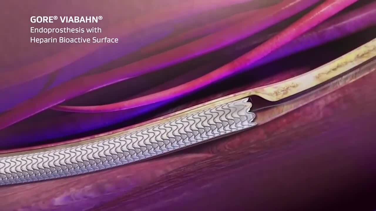 ゴア® バイアバーン® ステントグラフト | 日本ゴア メディカル製品