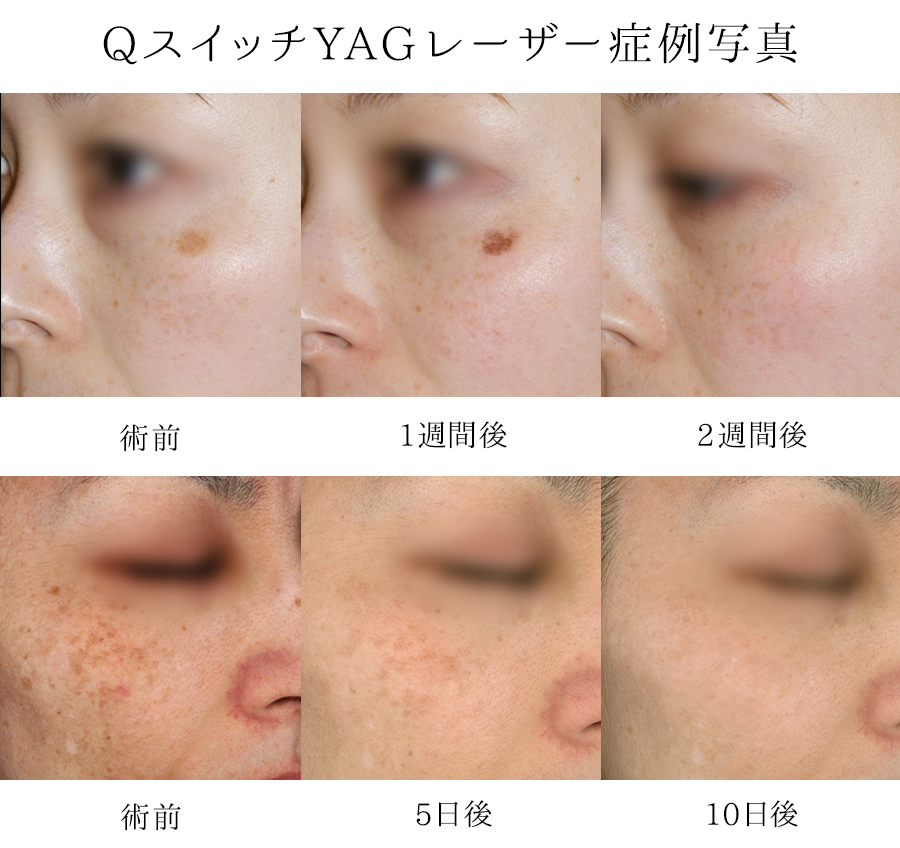 しみ・そばかす・くすみ（YAGレーザー）シュシュレディースクリニック