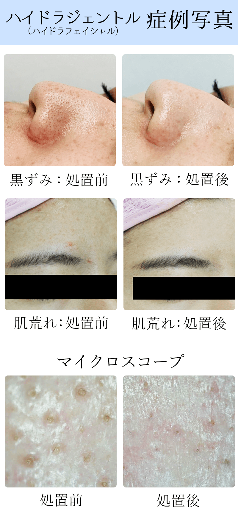 ハイドラフェイシャル（ハイドラジェントル）埼玉県のシュシュ