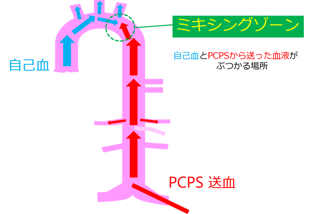 PCPS（VA‐ECMO）装着中の看護 Vol.2 | ICU看護師ダンカンの心外ブログ