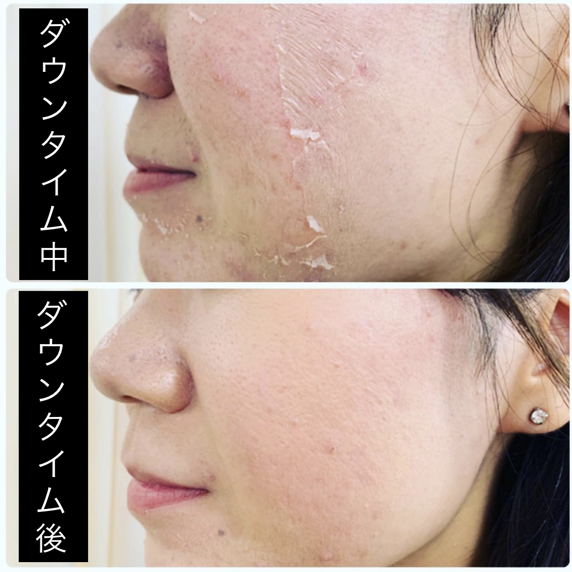 ダウンタイム写真】クリスタルハーブピーリング※剥離あり | シャルム