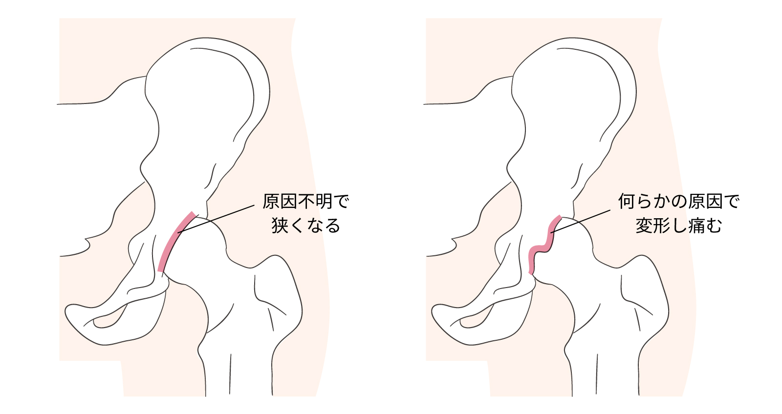 股関節のしくみと代表的な股関節の病気 | 千葉白井病院 人工関節センター