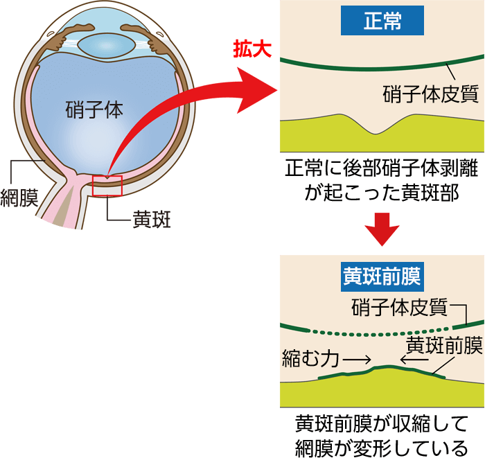 網膜硝子体 | 硝子体治療｜中京眼科