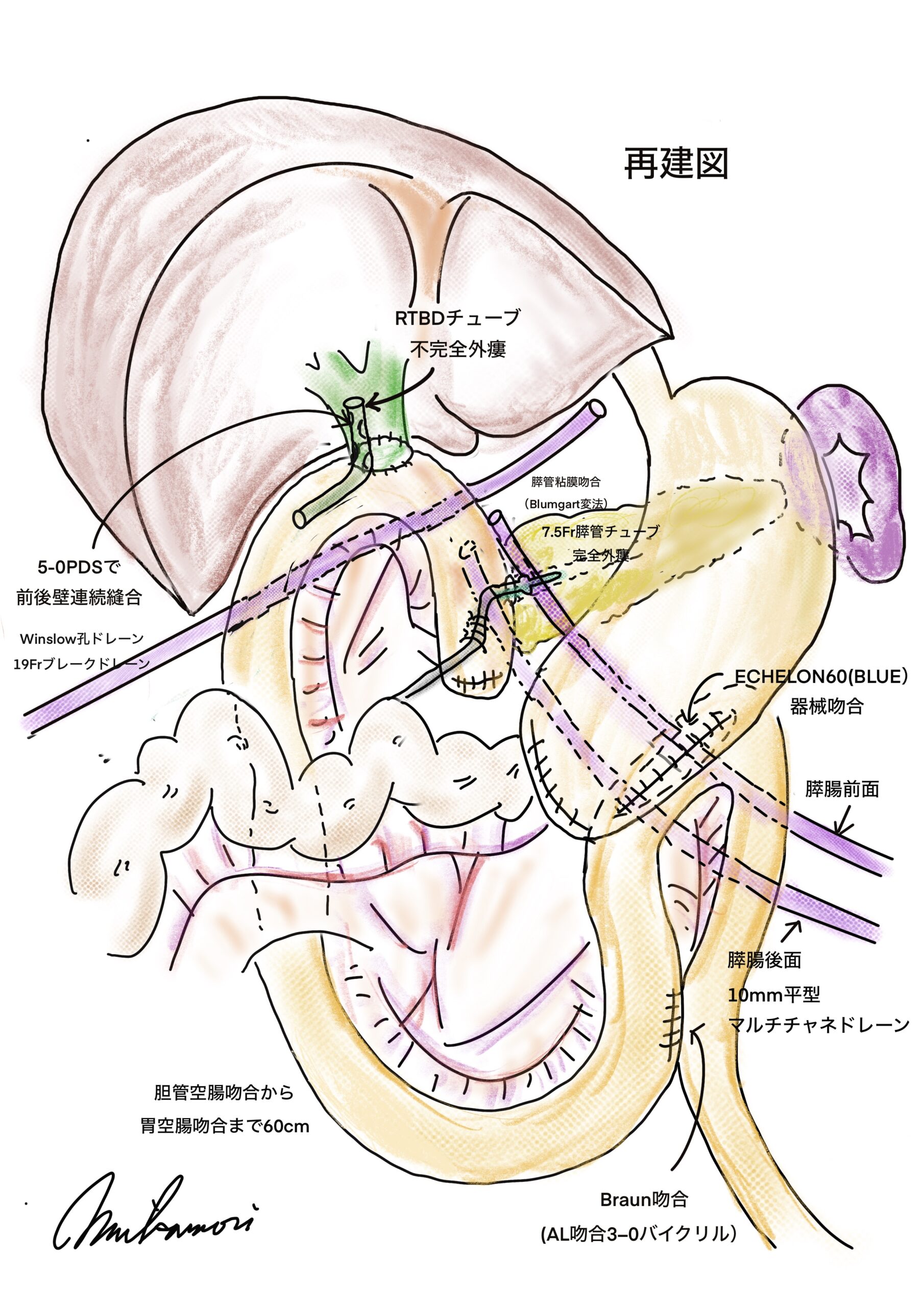 外科医の手術記録（オペレコ）とは？ - 西宮敬愛会病院 COKU 鼠径