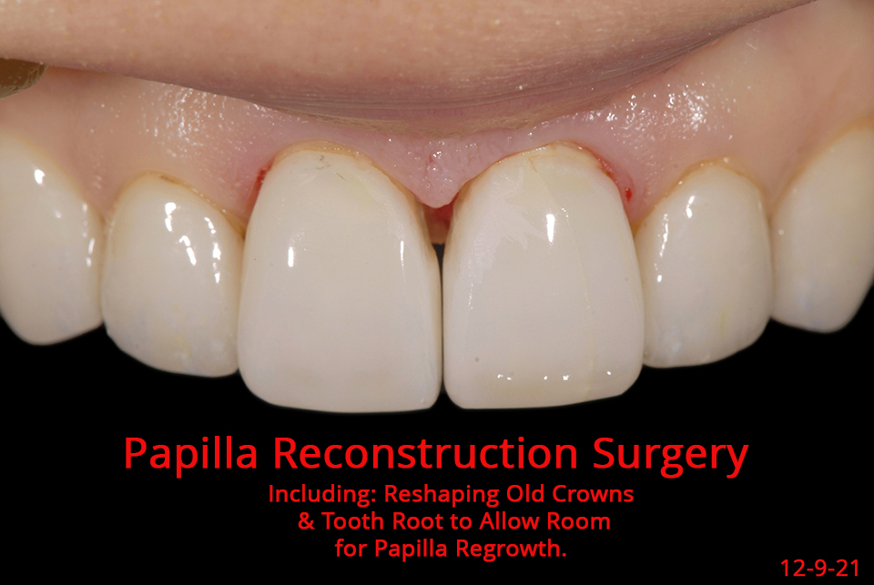 Interdental Papilla Reconstruction All Options - Advanced Cosmetic