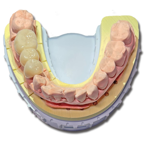 歯科技工物/クラウンブリッジ | 歯科技工所 コットンテール