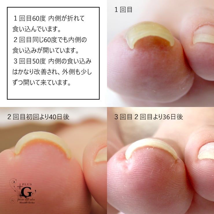 初回ケア代￥1500/1本無料】痛くない巻き爪補正ペディグラス☆着けた