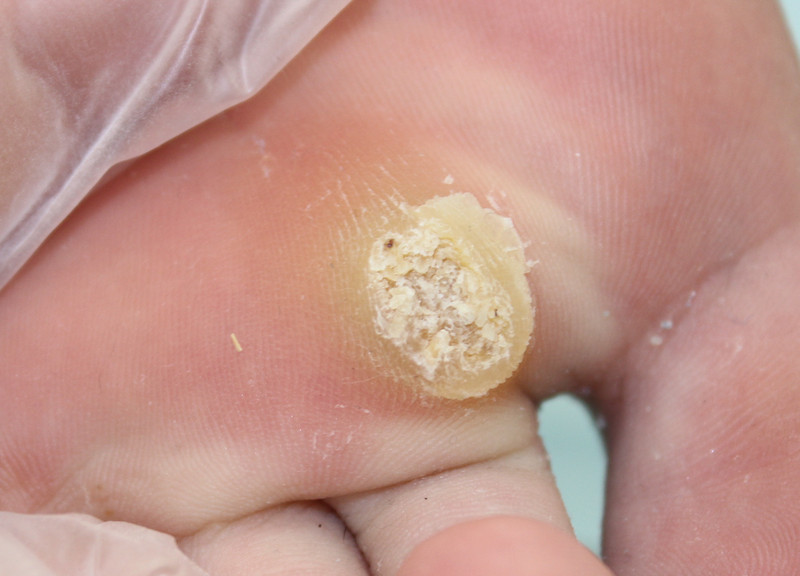 えぬくりブログ: イボ（いぼ、疣、尋常性疣贅）