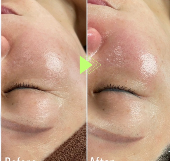 週末限定価格！ラミネーションピール/ラミピール/剥けないピーリング