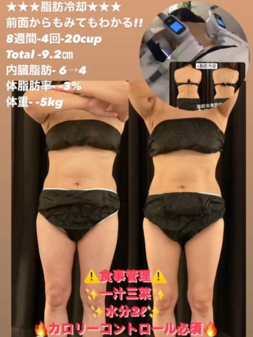 脂肪冷却☆beforeAfter | 脂肪冷却痩身専門店 Cryo Spa（クリオスパ）