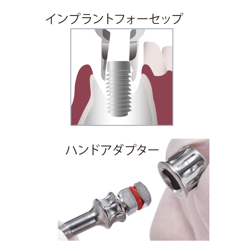 インプラントリムーバーキットの通販 | Ciモール | Ciモール