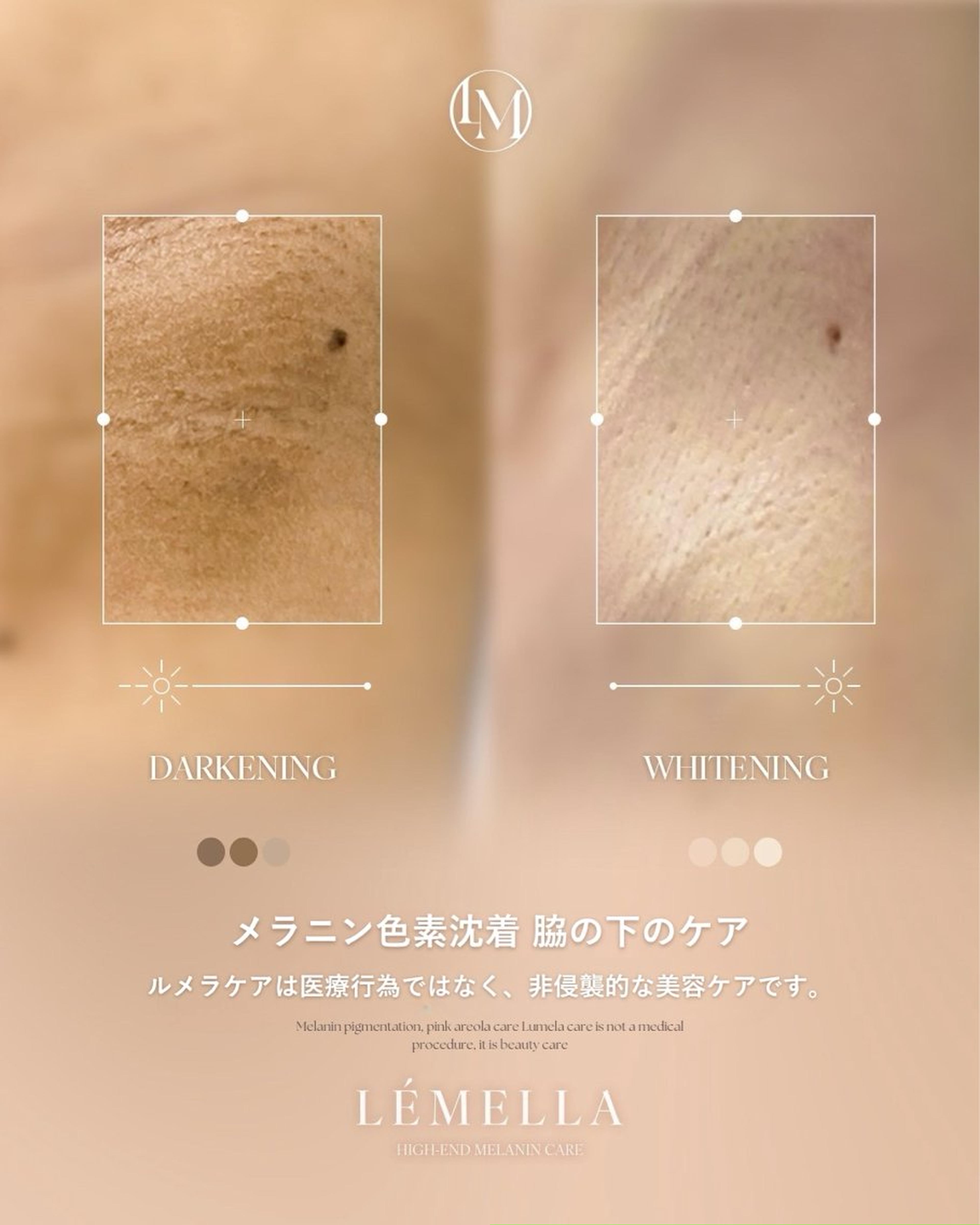 メラニンケアLÉMELLA（ルメラ） 【脇】Before After｜NAIL＆EYELASH