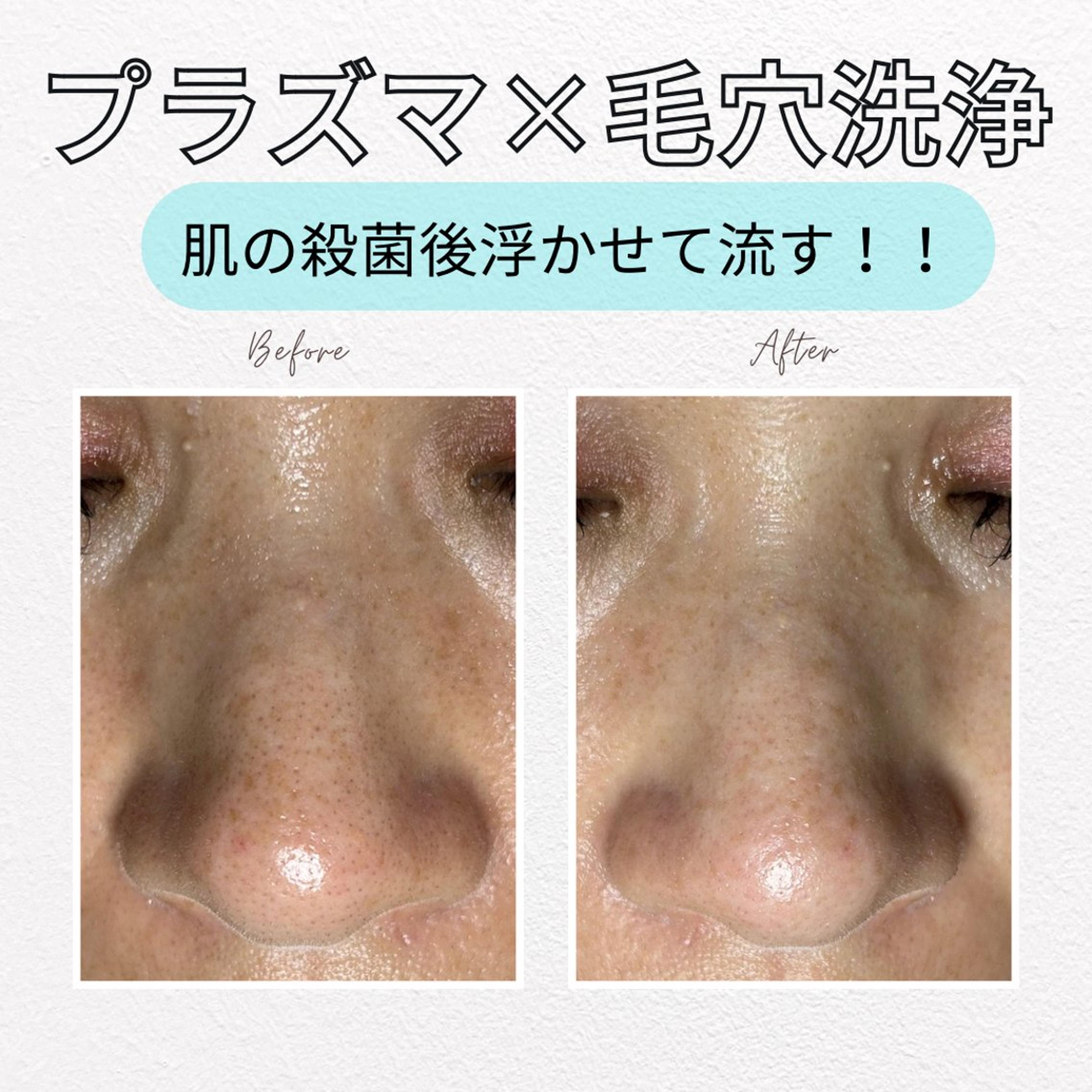 プラズマシャワー︎ハイドラフェイシャル 最強毛穴ケアメニューが登場