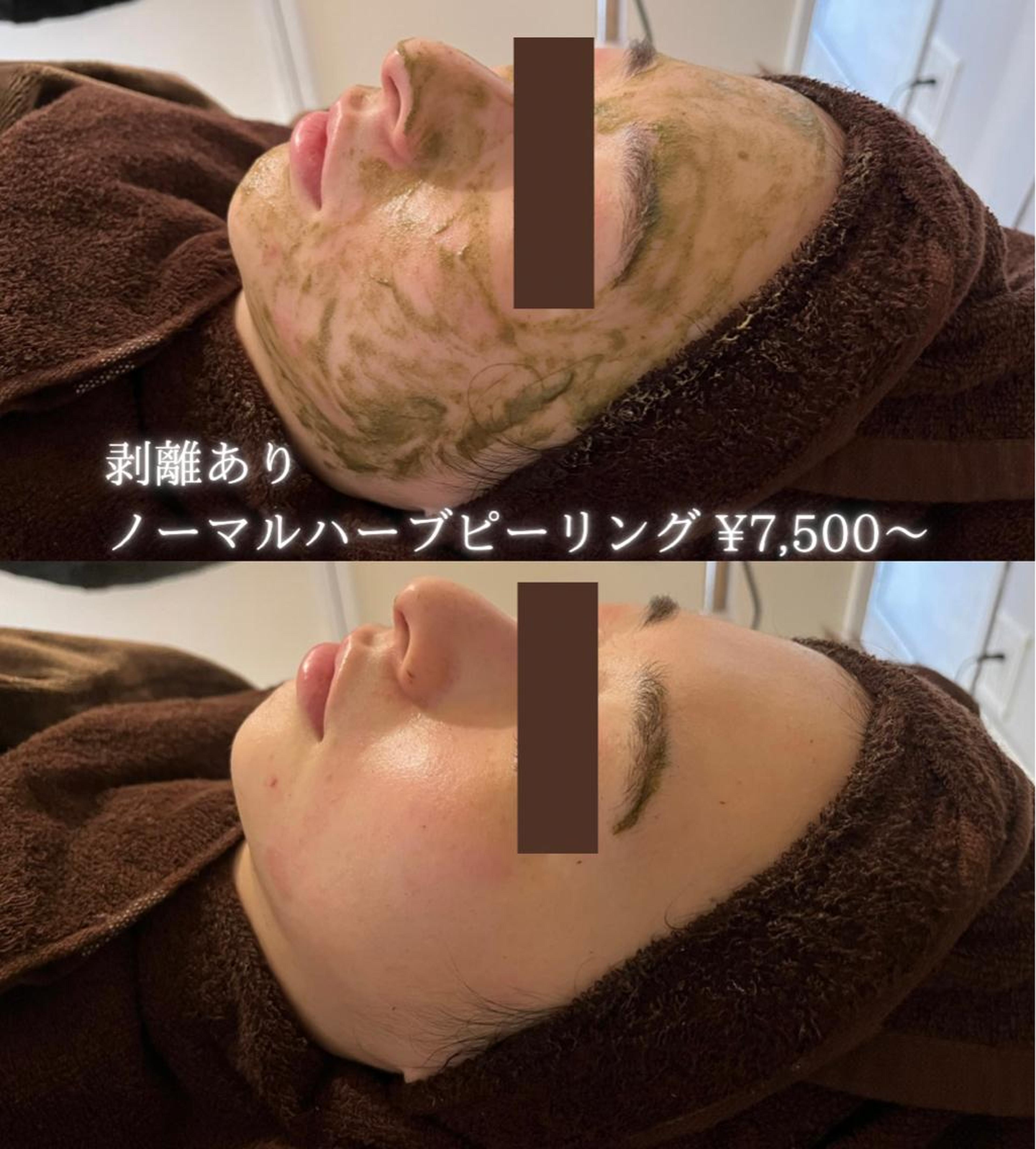 剥離ありハードハーブピーリング1回、剥離なしソフトハーブピーリング2