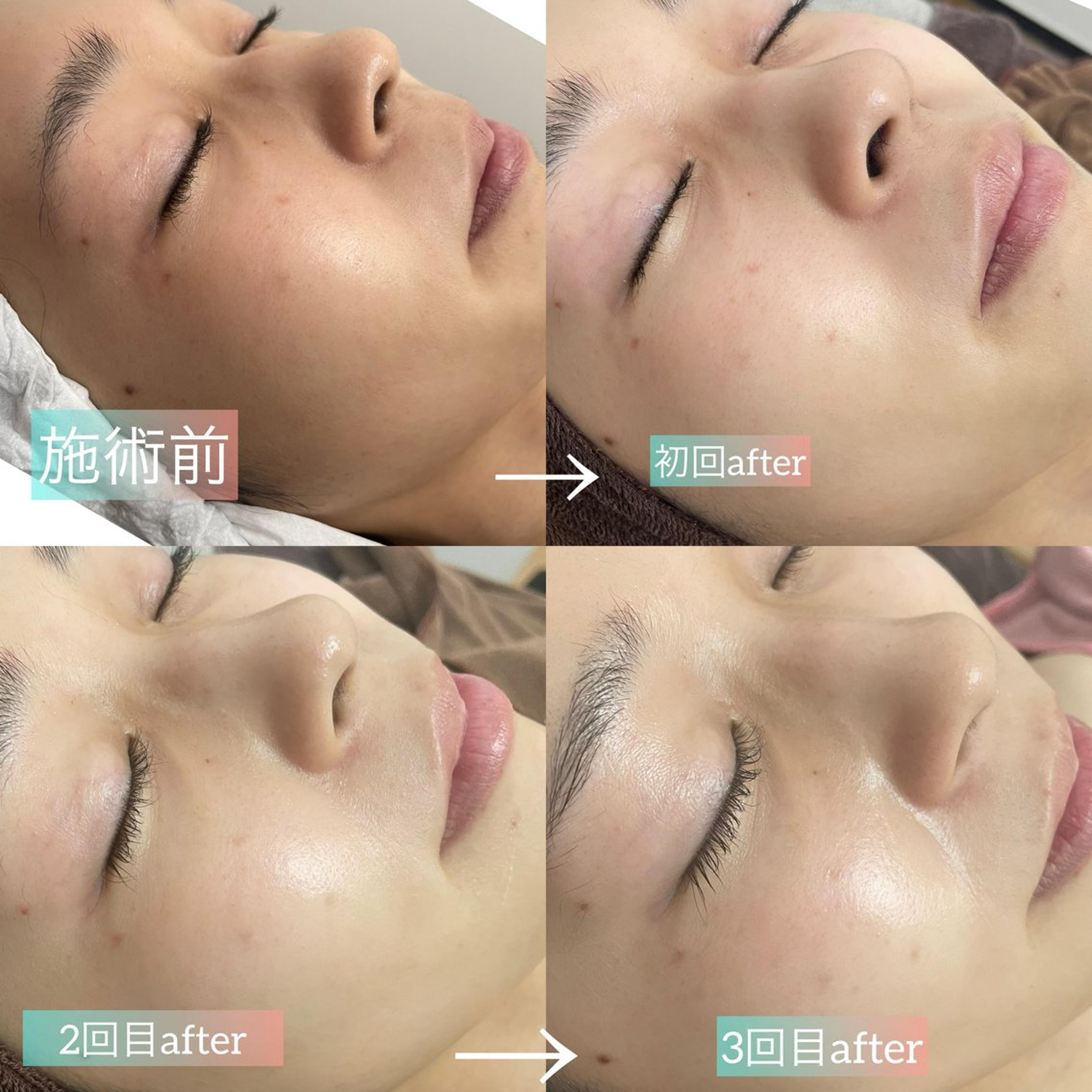 ハーブピーリング。剥離なし、ダウンタイムなし。 施術前のくすみ