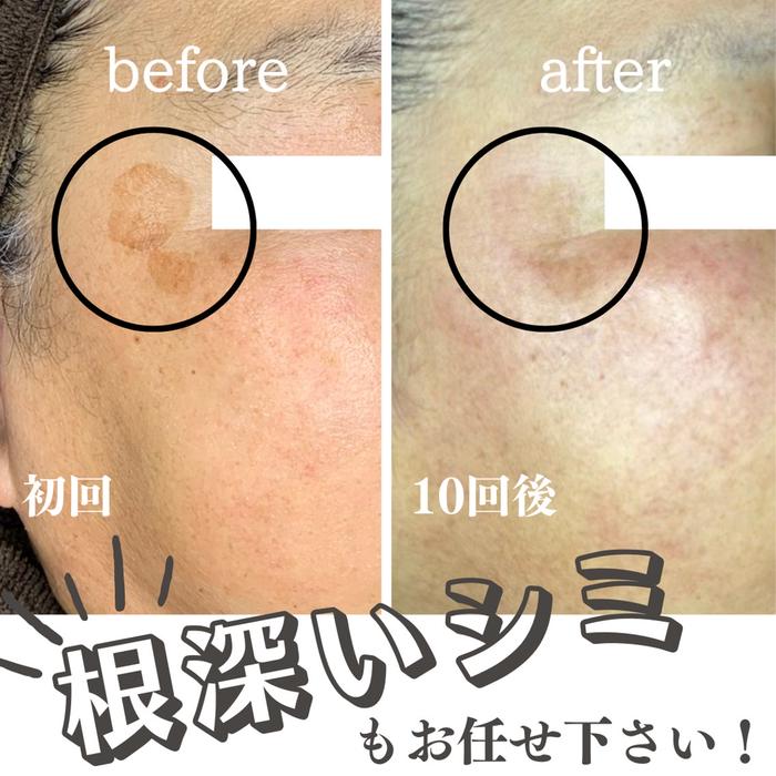 ✨️今だけ最安値最新型低周波シミ取りエステ✨️ ✨️今だけ