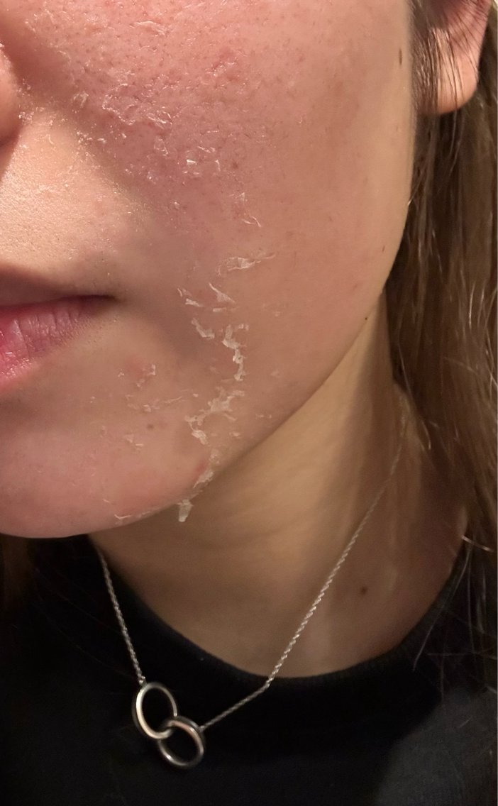 剥離ありハードハーブピーリング皮剥けの様子 ダウンタイム4日目のお肌