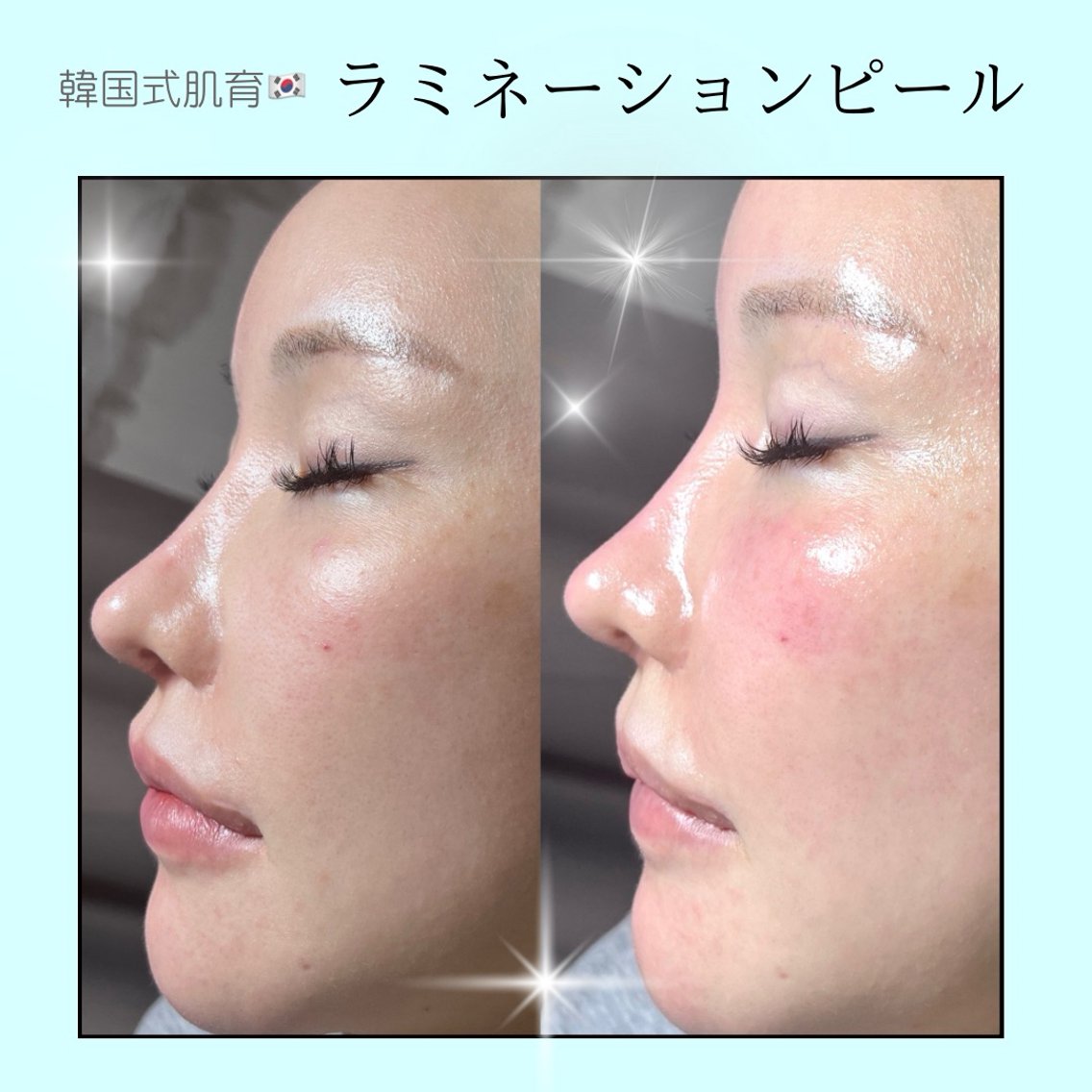 ラミピール 日本初上陸！ ダウンタイムなしの #肌育 ピーリング