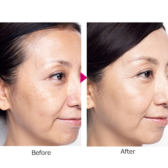 定期購入】[iGS4000]セレST限定セット超抗酸化サプリ&ジェル