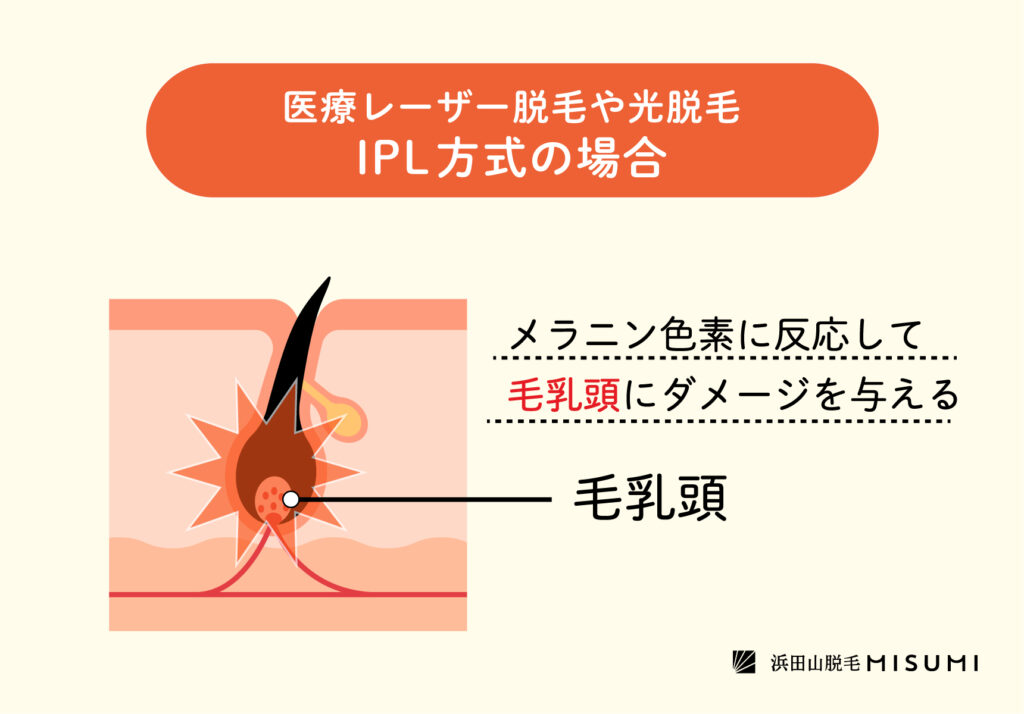 白髪は脱毛できない？その理由と脱毛の仕組みとは – 浜田山脱毛MISUMI