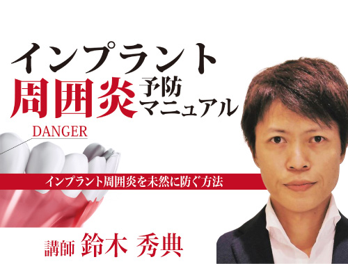 インプラント周囲炎 予防マニュアル | 医療情報研究所のDentalMovie