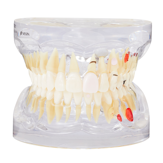 FEEDデンタル】成人 疾患説明用透明顎模型の通販｜カリエス・ペリオ
