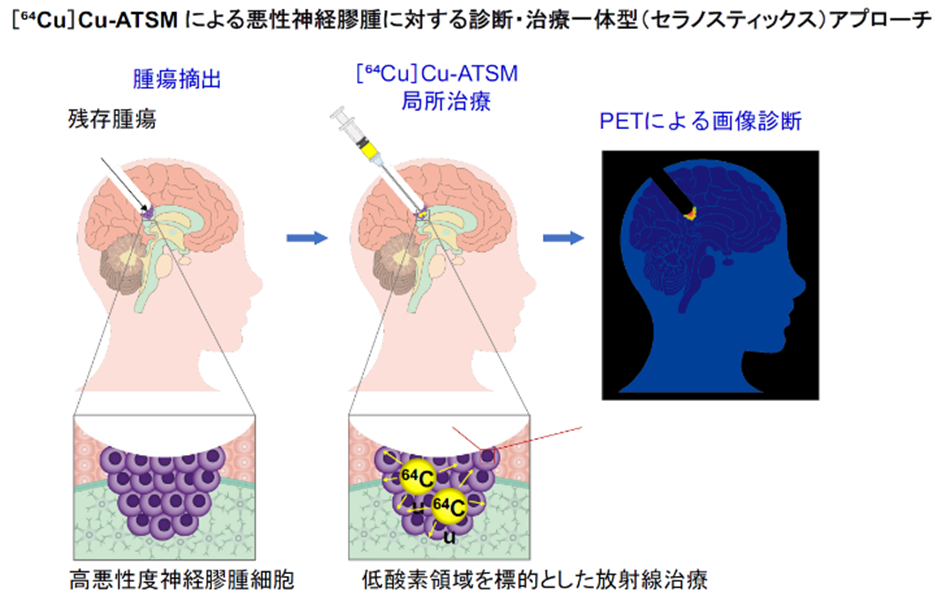 横浜市立大学】悪性脳腫瘍に対する“低酸素領域標的型”局所放射線治療の